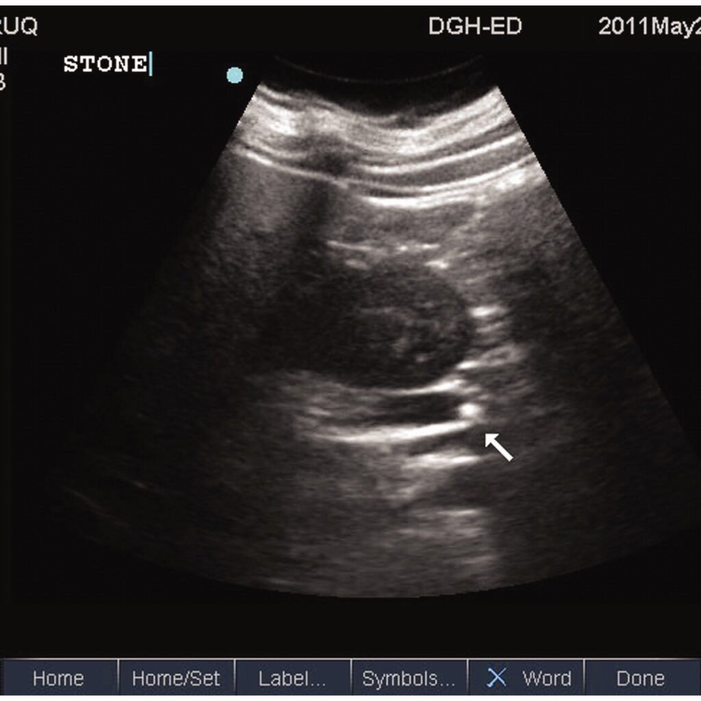 Renal Ultrasound CPT Code , Renal Ultrasound CPT , Renal Ultrasound