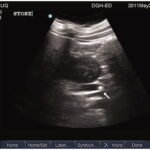Renal Ultrasound CPT Code: Navigating the Depths of Diagnostic Precision